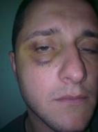 Ochiul invinetit al lui Marius Bodoc...